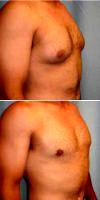 Dr. Sean T. Lille, MD, Scottsdale Plastic Surgeon Male Breast Reduction