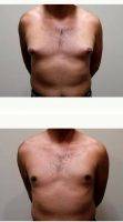 Dr. Shahriar Mabourakh, MD, FACS, Sacramento Plastic Surgeon 18-24 Year Old Man Treated With Male Breast Reduction