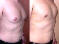 Dr. Sherwood Baxt, MD, Paramus Plastic Surgeon Liposuction For Gynecomastia (Male Breast Reduction)