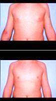 Dr. Steven J. Smith, MD, Knoxville Plastic Surgeon 15 Year Old Man Treated For Male Breast Reduction Surgery
