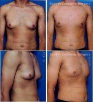 Dr. Steven Svehlak, MD, Los Angeles Plastic Surgeon Male Breast Reduction Gynecomastia Treated With Liposuction