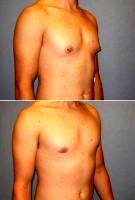 Dr. Steven Vath, MD, Denver Plastic Surgeon 21 Year Old Gynecomastia (male Breast Reduction) Patient
