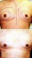 Dr. Stuart A. Linder, MD, FACS, Beverly Hills Plastic Surgeon Male Breast Reduction