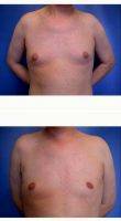 Dr. Suzanne M. Quardt, MD, Palm Springs Plastic Surgeon Male Breast Reduction