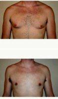 Dr. Tim Neavin, MD, Beverly Hills Plastic Surgeon 35-44 Year Old Man Treated With Male Breast Reduction