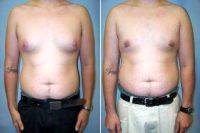 Dr. Tom J. Pousti, MD, FACS, San Diego Plastic Surgeon Male Breast Reduction (gynecomastia)