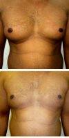 Dr. William Townley, MD, FRCS(Plast), London Plastic Surgeon 18-24 Year Old Man Treated With Male Breast Reduction