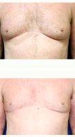 Dr. Zoran Potparic, MD, Fort Lauderdale Plastic Surgeon 45-54 Year Old Man Treated With Male Breast Reduction