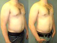 Gynecomastia Before And After Pic