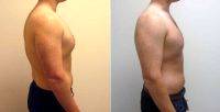 Gynecomastia By Doctor Jay M. Pensler, MD, Chicago Plastic Surgeon