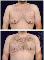 Gynecomastia By Doctor Michael Law, MD, Raleigh-Durham Plastic Surgeon