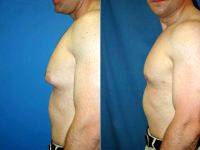 Gynecomastia Correction In A Bodybuilder By Doctor Kurtis Martin, MD, Cincinnati Plastic Surgeon