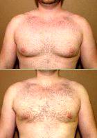 Gynecomastia Correction (male Breast Correction) By Dr Gregory Turowski, MD, PhD, FACS, Chicago Plastic Surgeon