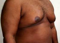 Gynecomastia Is Enlargement Of The Glandular Tissue Of The Male Breast