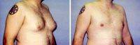 Gynecomastia-Liposuction By Dr. David F. Pratt, MD, Kirkland Plastic Surgeon