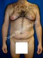 Gynecomastia, Liposuction For Men, Tummy Tuck (Abdominoplasty) With Dr Tom J. Pousti, MD, FACS, San Diego Plastic Surgeon