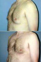 Gynecomastia (Male Breast Reduction) On 47-year-old With Dr. Jed H. Horowitz, MD, FACS, Orange County Plastic Surgeon