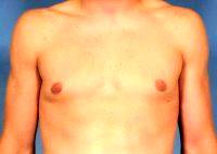 Gynecomastia - Male Breast Reduction With Doctor Kent V. Hasen, MD, Naples Plastic Surgeon