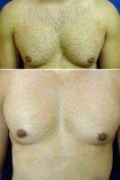 Gynecomastia (Male Breast Reduction) With Dr Vincent D. Lepore, MD, San Jose Plastic Surgeon
