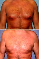 Gynecomastia On 36-year-old With Doctor Jed H. Horowitz, MD, FACS, Orange County Plastic Surgeon