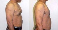 Gynecomastia Pic By Doctor Jay M. Pensler, MD, Chicago Plastic Surgeon