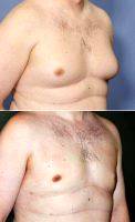Gynecomastia Reduction By Doctor Barry L. Eppley, MD, DMD, Indianapolis Plastic Surgeon