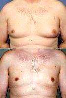 Gynecomastia Reduction By Dr. Barry L. Eppley, MD, DMD, Indianapolis Plastic Surgeon