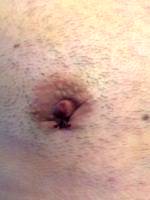 Gynecomastia Surgery Nipple Scar (2)