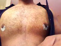 Gynecomastia Surgery Nipple Scar (3)