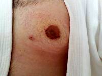 Gynecomastia Surgery Nipple Scar (5)