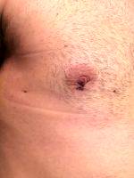 Gynecomastia Surgery Nipple Scar (6)