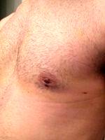 Gynecomastia Surgery Nipple Scar (7)