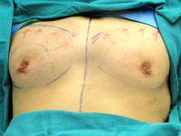 Gynecomastia Surgery Results