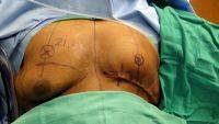 Gynecomastia Surgery Scar Tissue