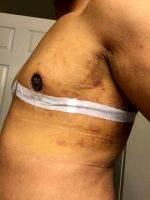 Gynecomastia Surgery Scars Pic