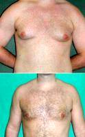 Gynecomastia Treated By Liposuction By Dr Steven Wallach, MD, New York Plastic Surgeon