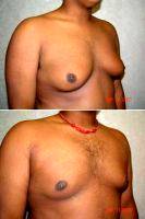 Gynecomastia With Doctor Ira H. Rex Lll, MD, Fall River Plastic Surgeon