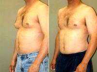 Gynecomastia With Doctor Michael A. Epstein, MD, FACS, Chicago Plastic Surgeon