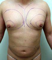 How Much Gynecomastia Surgery Cost