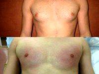 Liposuction For Gynecomastia (Male Breast Reduction) Before After With Doctor Sherwood Baxt, MD, Paramus Plastic Surgeon (2)