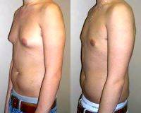 Liposuction Of Gynecomastia With Doctor Bruce K. Barach, MD, Schenectady Plastic Surgeon