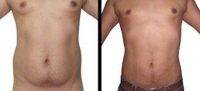 MALE LIPOSCULPTURE WITH BREAST REDUCTION By Doctor Carlos Lopez Collado, MD, Dominican Republic Plastic Surgeon