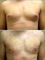 Male Breast Reduction Before After With Dr William J. Hedden, MD, Birmingham Plastic Surgeon (1)