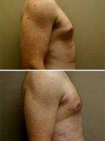 Male Breast Reduction Before After With Dr William J. Hedden, MD, Birmingham Plastic Surgeon (2)