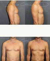 Male Breast Reduction By Doctor Dana Goldberg, MD, Jupiter Plastic Surgeon