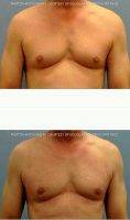Male Breast Reduction By Doctor Douglas Hendricks, MD, Newport Beach Plastic Surgeon