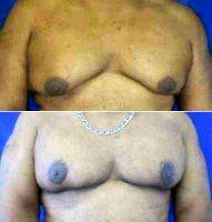 Male Breast Reduction By Doctor Kenneth B. Hughes, MD, Los Angeles Plastic Surgeon