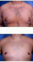 Male Breast Reduction By Doctor Suzanne M. Quardt, MD, Palm Springs Plastic Surgeon