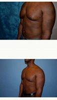 Male Breast Reduction By Dr Alan N. Larsen, MD, Atlanta Plastic Surgeon