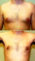 Male Breast Reduction By Dr John Nguyen, MD, FACS, Houston Plastic Surgeon